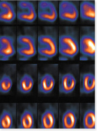 nuclear medicine scan heart